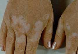 Mans con vitiligo